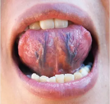 从舌头看健康你是这七种体质中的哪一种
